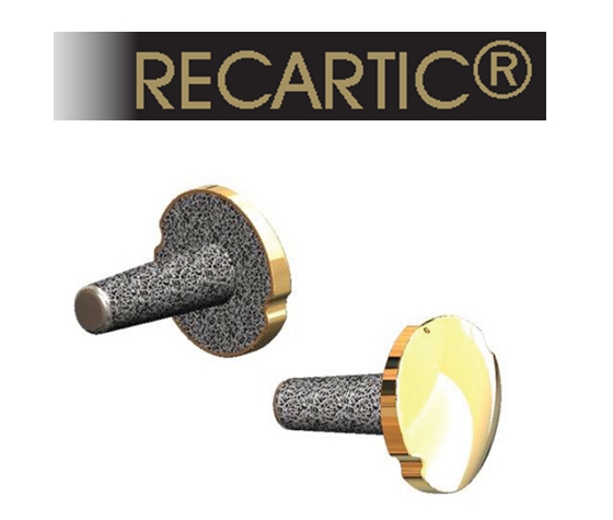 Recartic® - имплантант для частичной замены артикуляционной поверхности коленного сустава